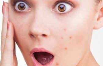 جلوگیری از جوش صورت در تابستان