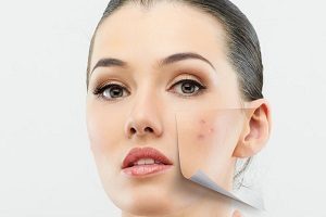 جلوگیری از جوش های روی صورت در فصل تابستان